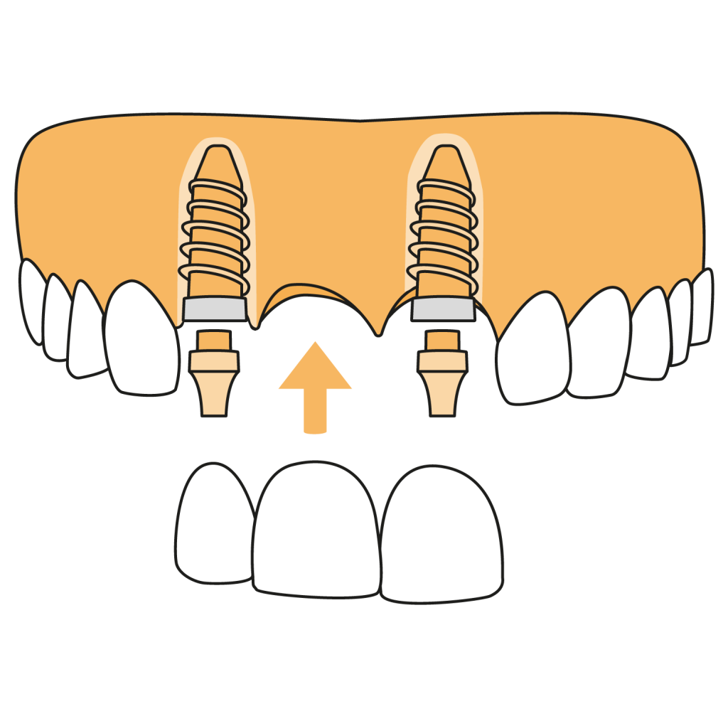 Full Mouth Dental Implants