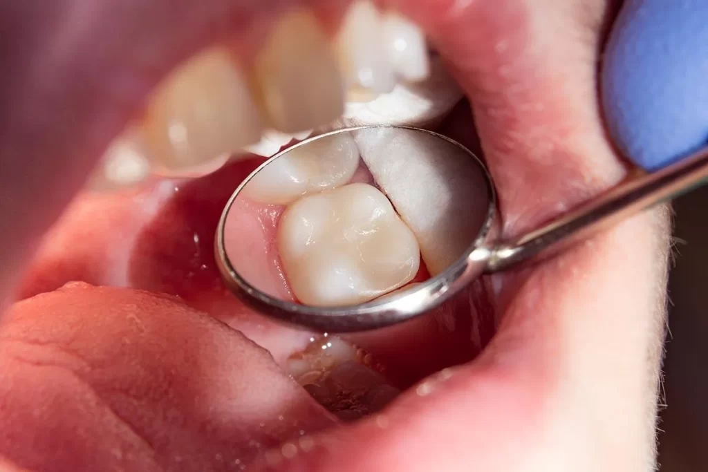 Teeth filling