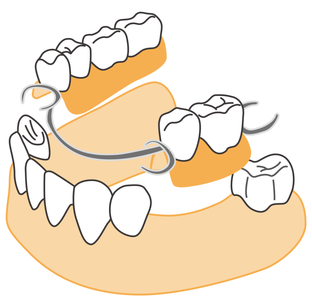 Dental Bridges