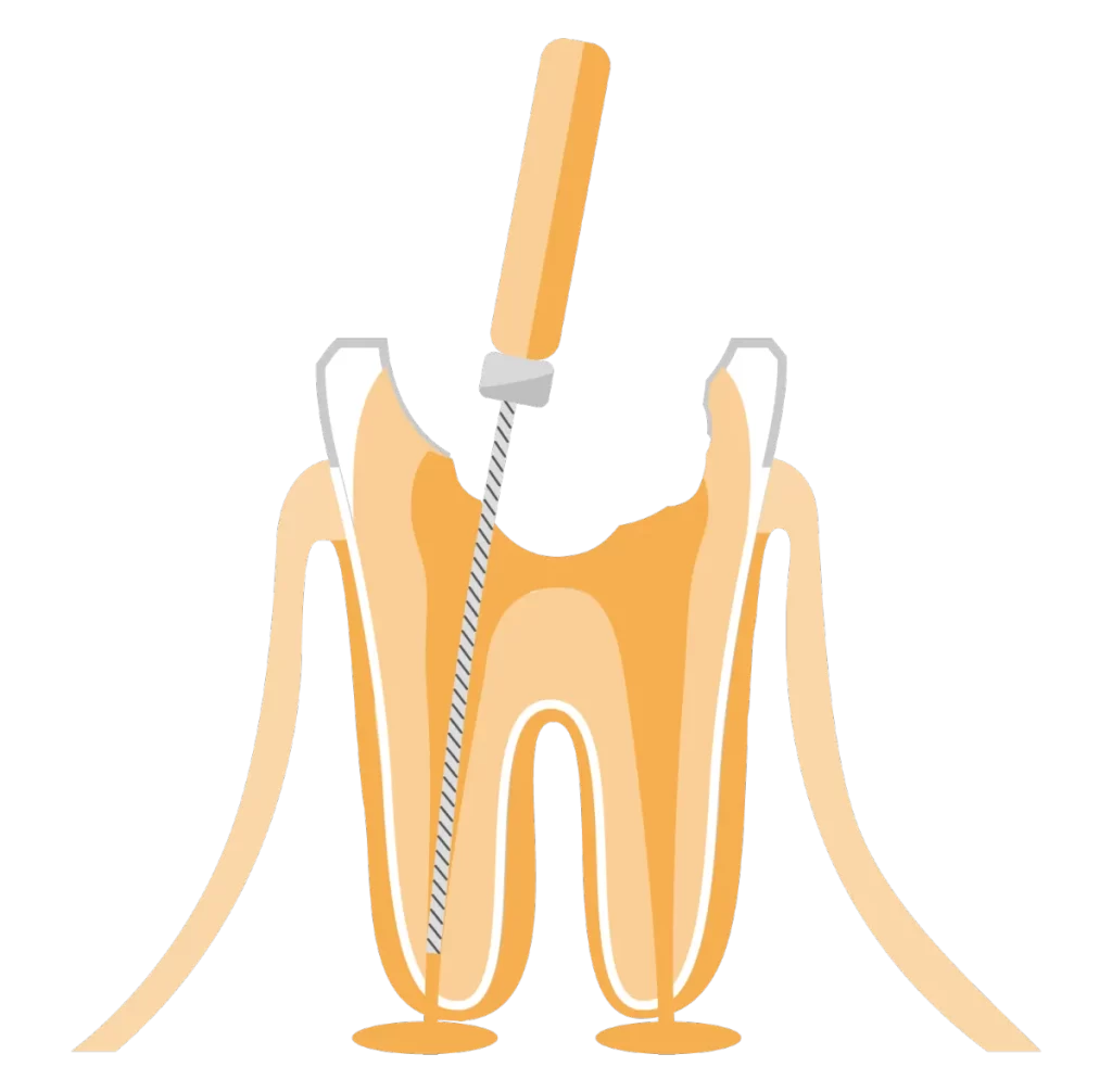 Dental Filling
