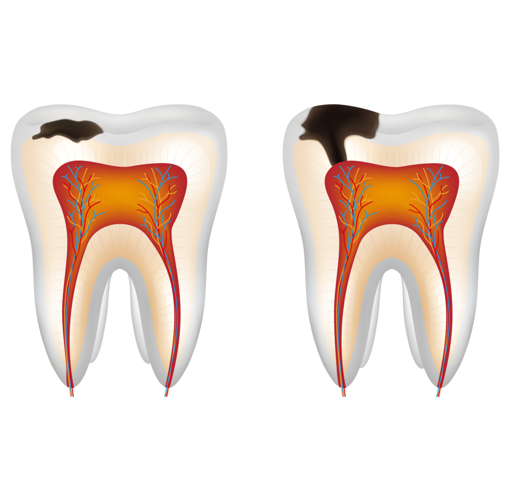 Cavities