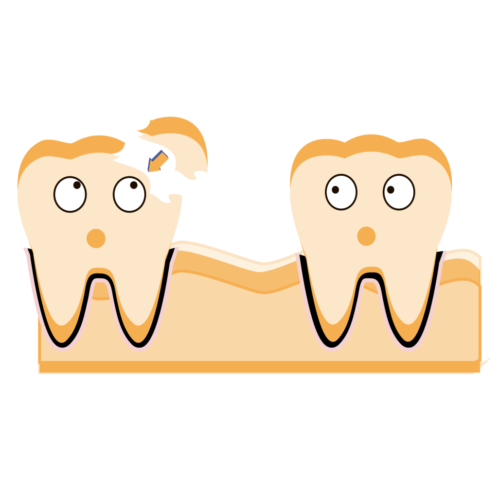 chipped tooth
