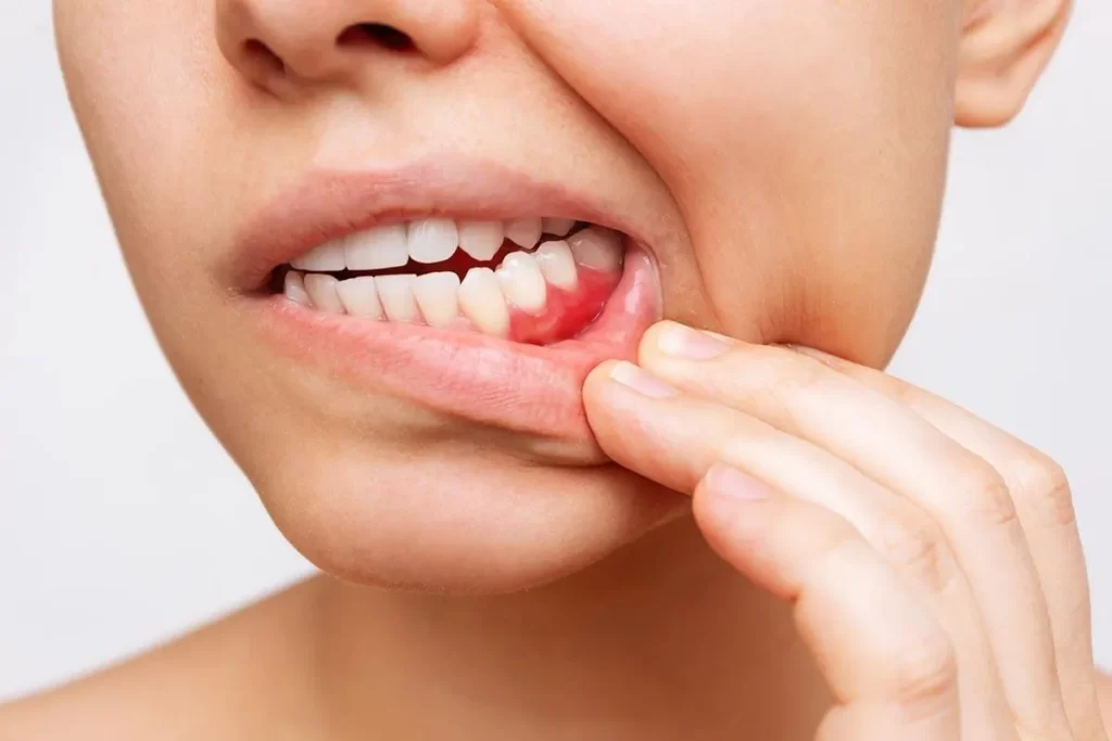 TMJ Disorder