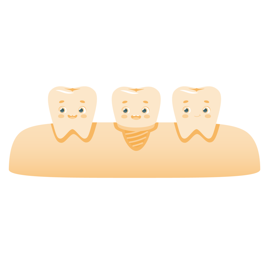 Multiple Tooth Implants