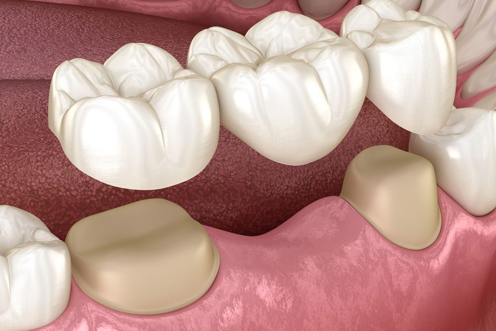 Missing Teeth