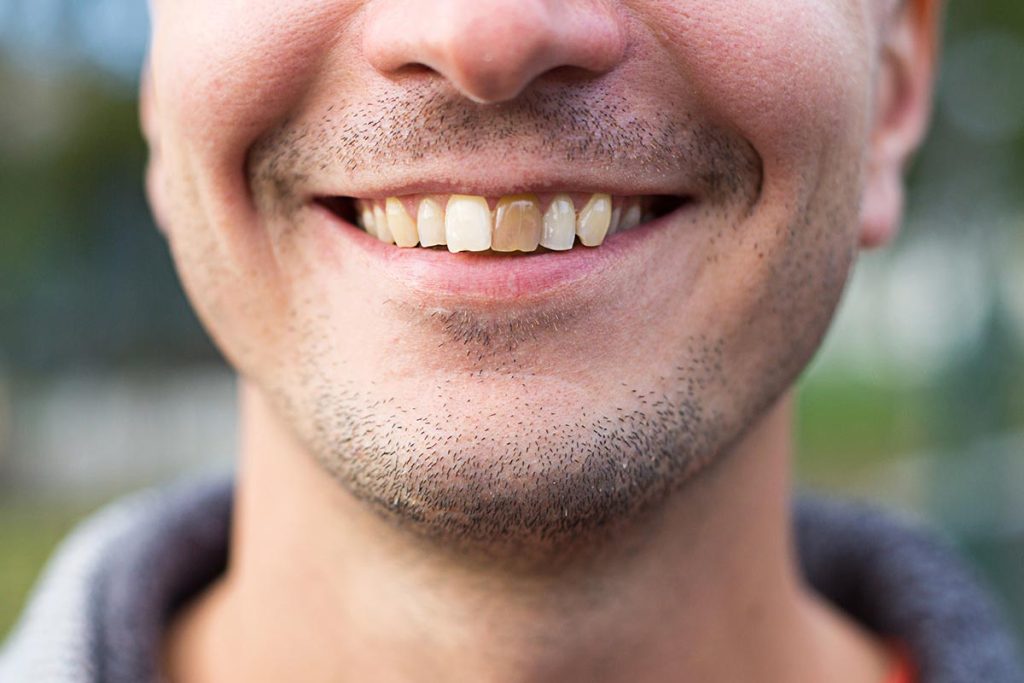 Damage tooth