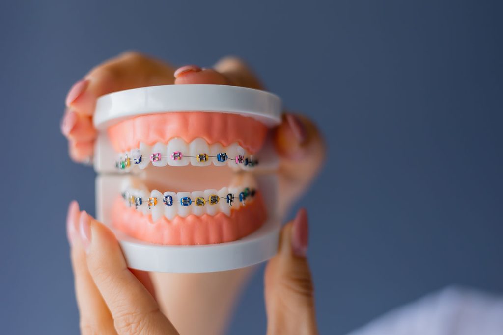 Dental Braces