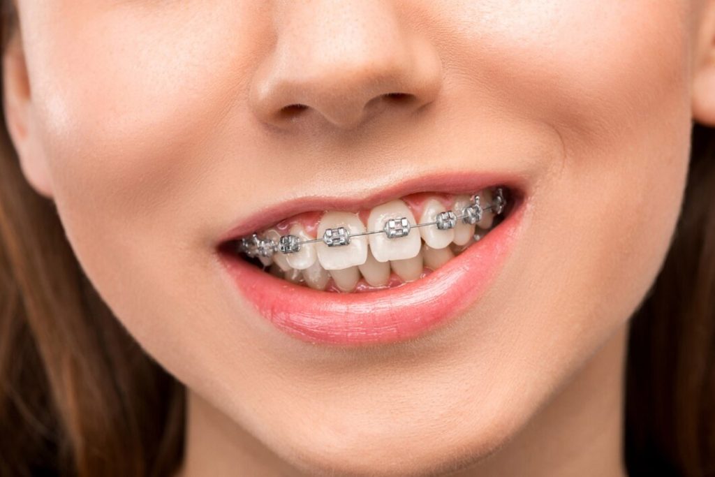 Metal Braces