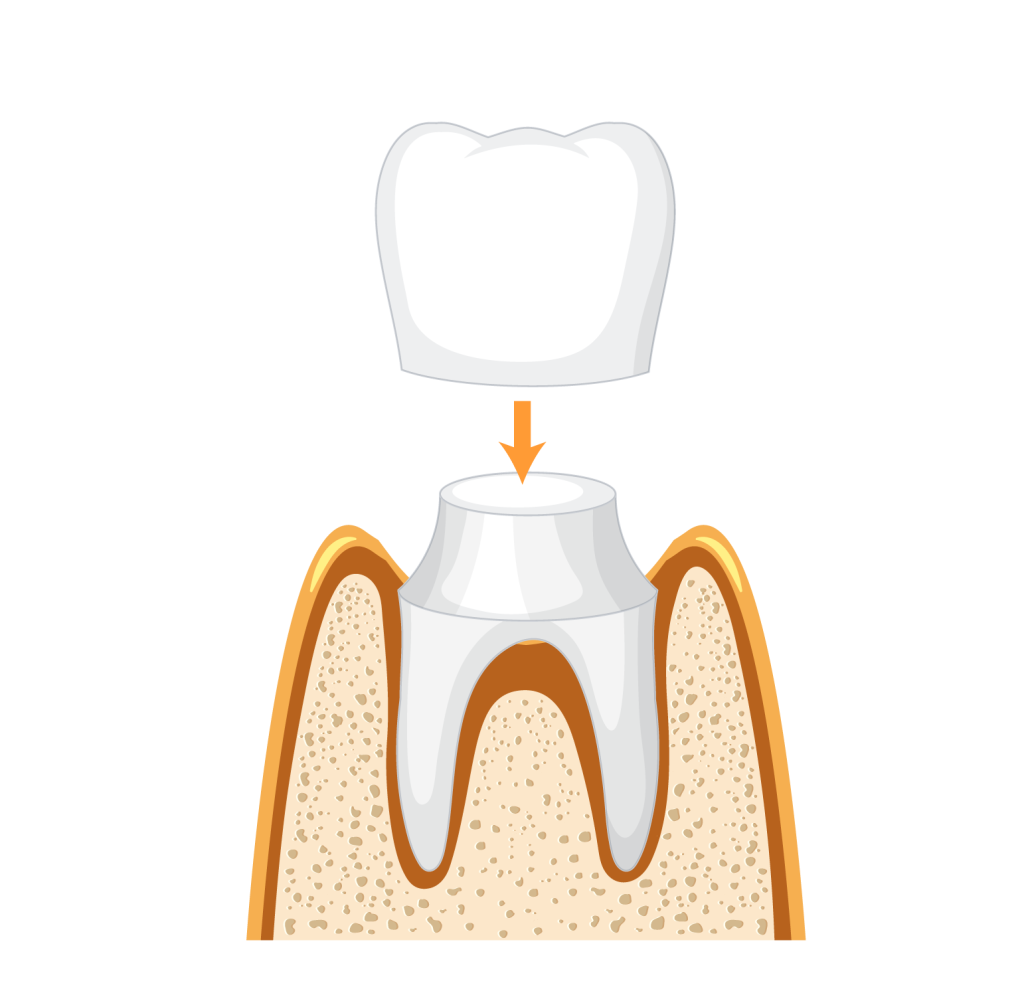 CEREC
