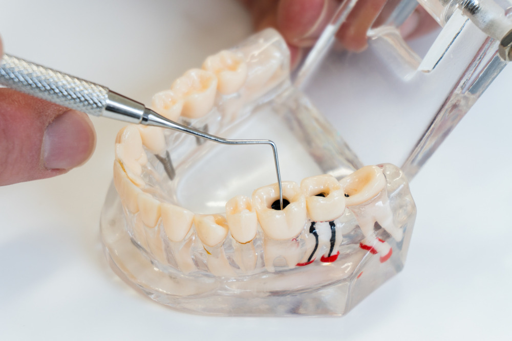 Root Canal Therapy