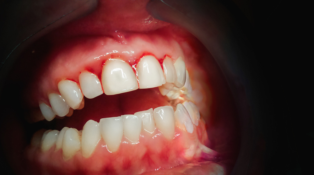 Gum Disease
