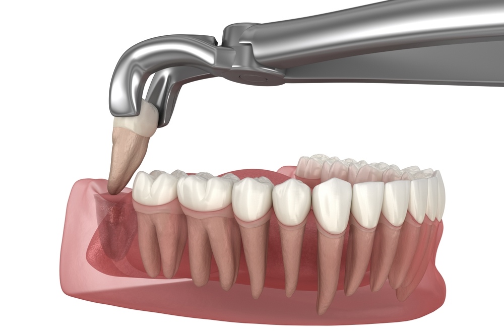 A Dentist's Guide to Wisdom Tooth Extractions vs. Regular Extractions