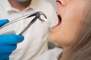 wisdom tooth extractions