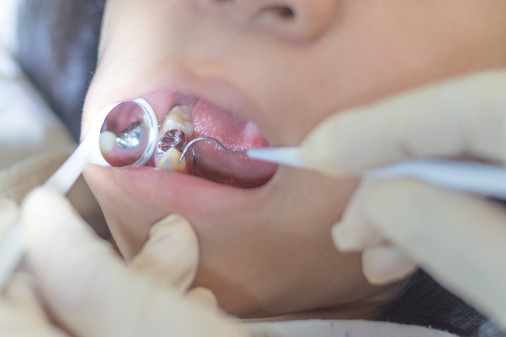 Dental Sealants