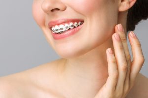 metal teeth braces