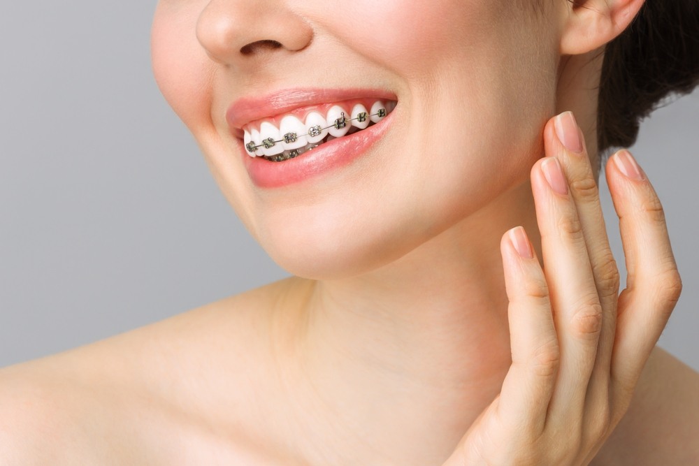 metal teeth braces