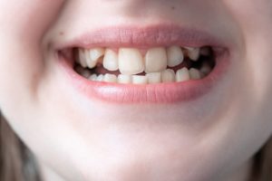 crooked teeth