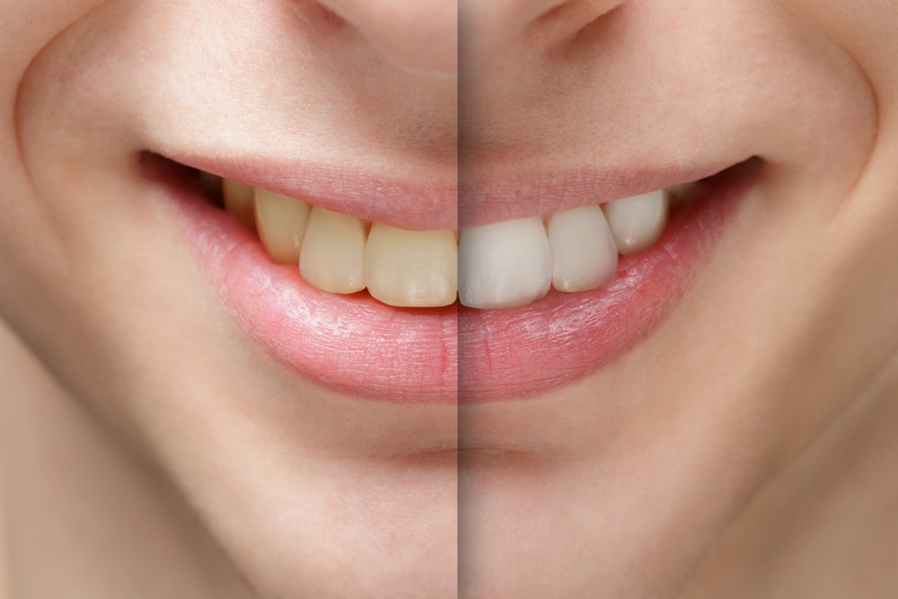 Professional Teeth Cleaning