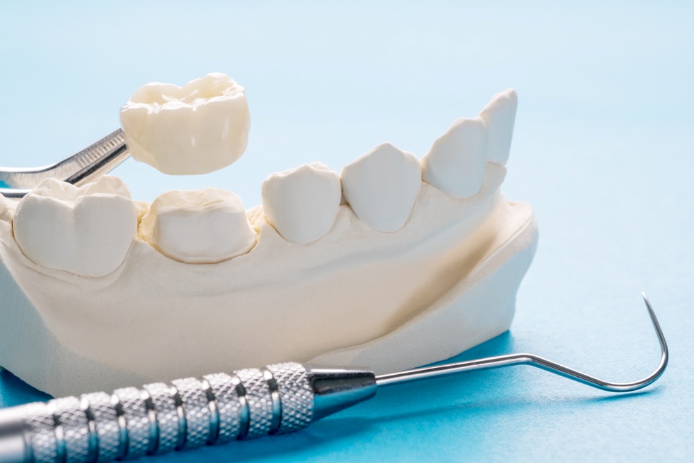 CEREC Same Day Crowns