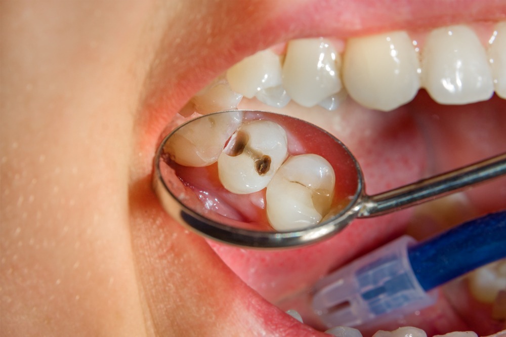Tooth Implants