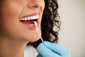 Porcelain Veneers