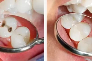 Restoring Your Smile
