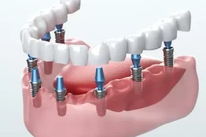 The Implants​