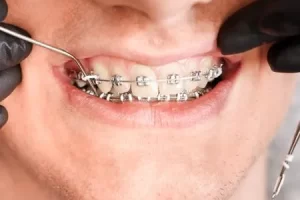 Orthodontics / Invisible Aligners​